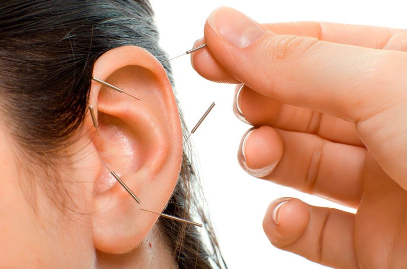 Você Conhece a acupuntura orelha ou acupuntura auricular ou Auriculoterapia?